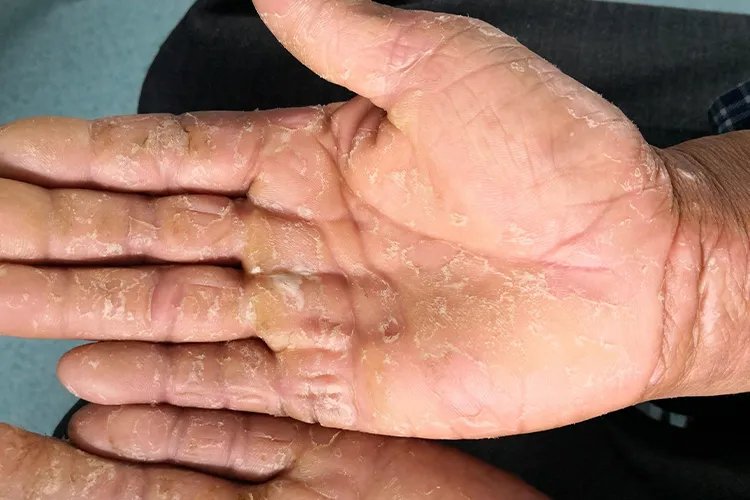 汗疱疹的症状图片