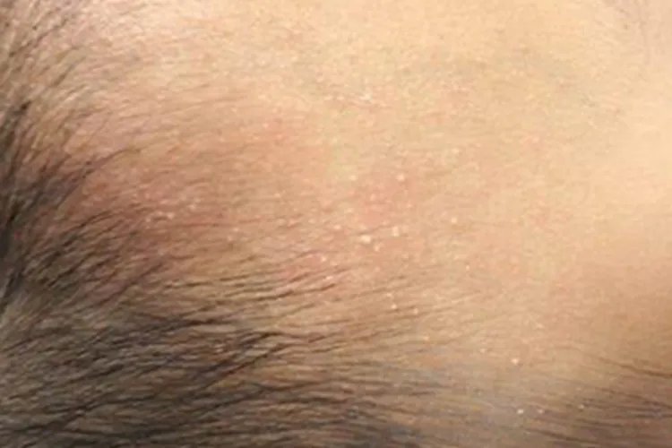 痱子小疙瘩图片