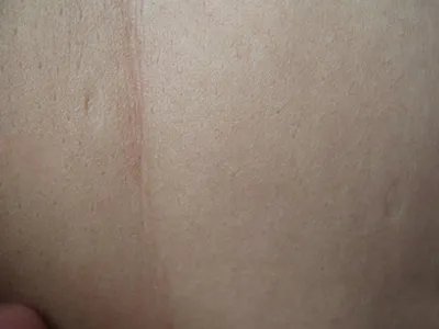 Pasini-Pierni进行性特发性皮肤萎缩斑图片