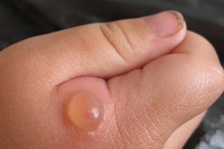 蚤病大水疱图片