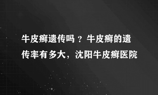 牛皮癣遗传吗 ？牛皮癣的遗传率有多大，沈阳牛皮癣医院