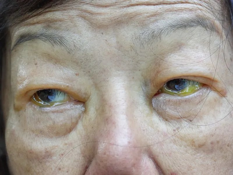 扁平疣和老年斑的区别有哪些，平时如何抑制老年斑的形成？