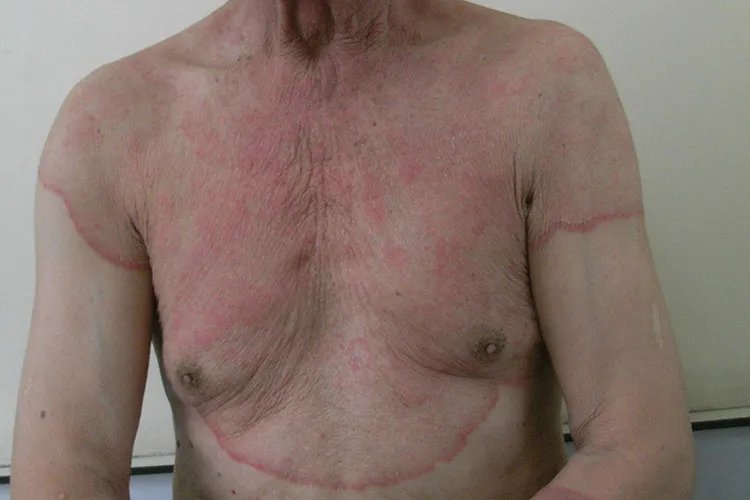 癣的种类与辨别图片