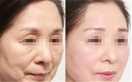 玻尿酸打一针多少钱