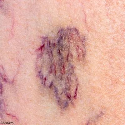 小儿过敏性紫癜怎么办 揭秘小儿过敏性紫癜的几个消除方法