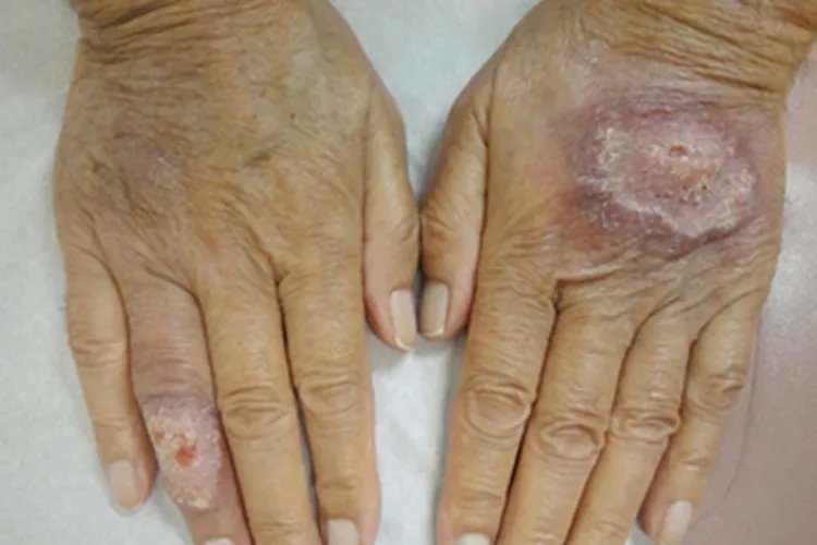 利什曼病手部溃疡图片