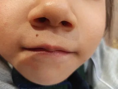 交界痣口周斑图片