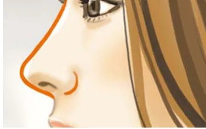 深圳假体隆鼻哪家医院好