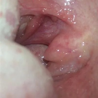 掏耳朵咳嗽是怎么回事?