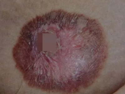 乳房湿疹样癌脱皮图片