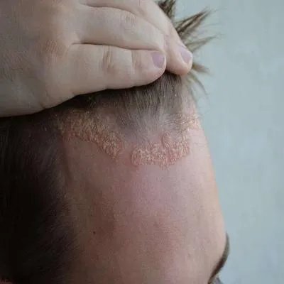 脂溢性皮炎中医能治好吗 三个中医方法控制脂溢性皮炎