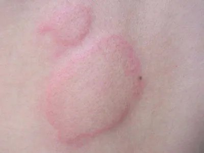 荨麻疹初期症状图片