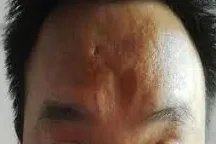 额头凹陷图片