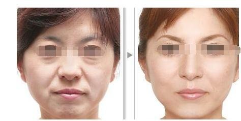 玻尿酸功效有哪些