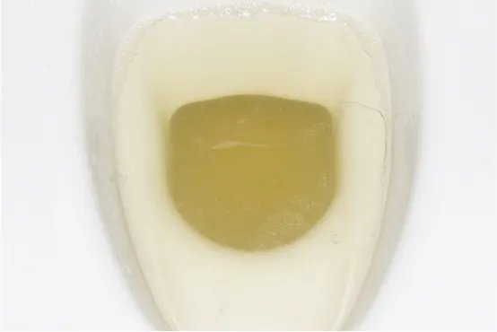 尿胆原偏高是怎么回事