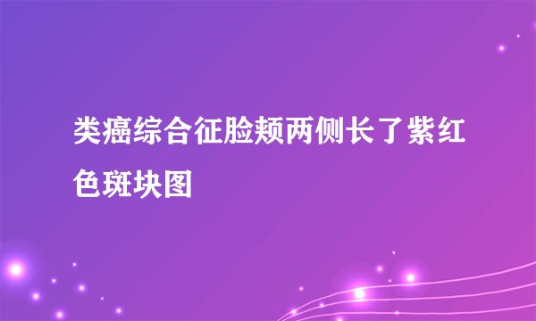 类癌综合征脸颊两侧长了紫红色斑块图