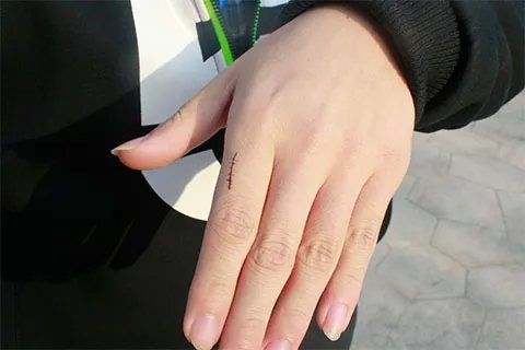 伤口化脓怎么办