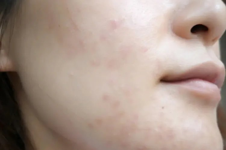 针清过程恢复图