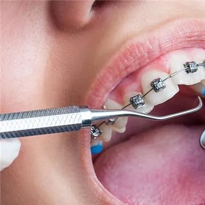 虫吃牙怎么治疗