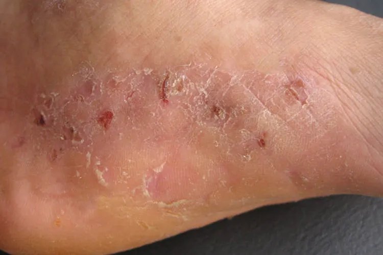 癣的种类与辨别图片