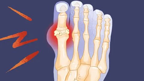 尿酸高的人不能吃什么东西