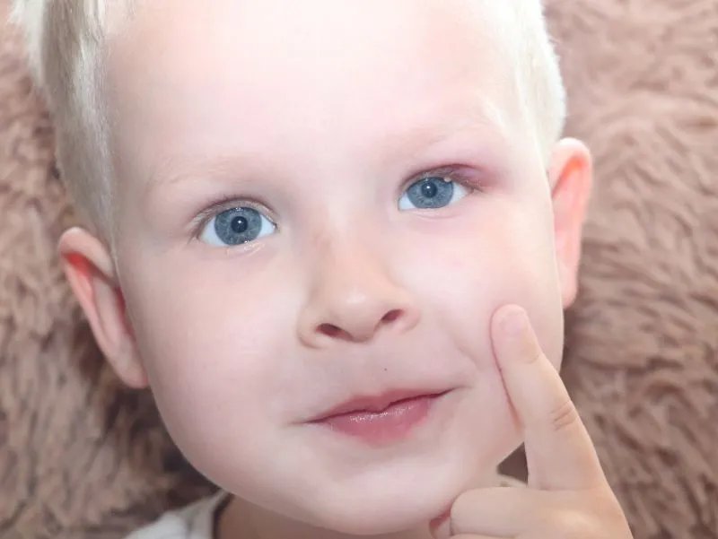 怎么预防红眼病