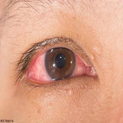 过敏性结膜炎用药注意事项是哪些