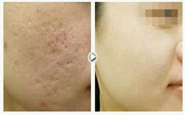 祛痘多少钱?