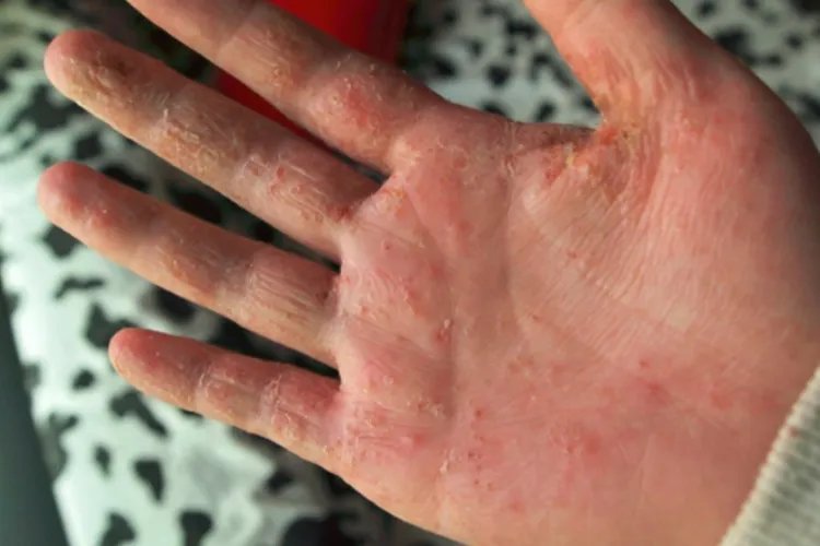 癣的种类与辨别图片