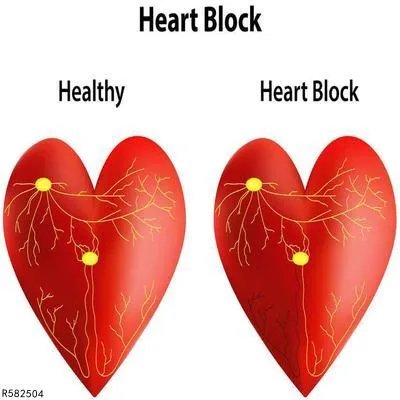 1度房室传导阻滞怎么治疗