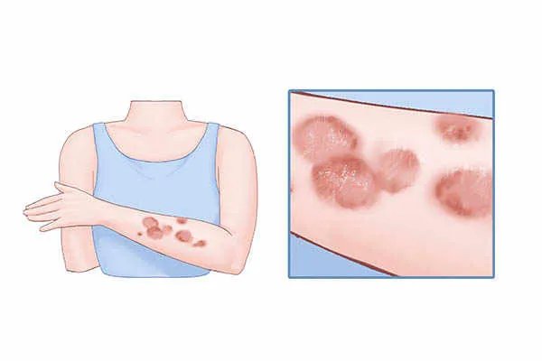 烫伤后怎么处理