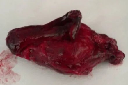 50天人流的胚胎图片