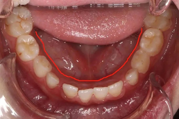 口腔舌侧颊侧腭侧区分图片
