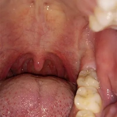 掏耳朵咳嗽是怎么回事?