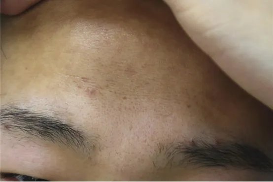 红色痘印怎么消除