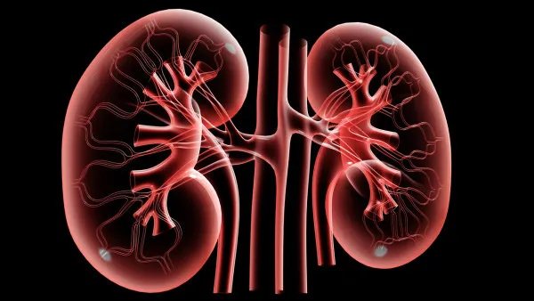 肾结石怎么治疗