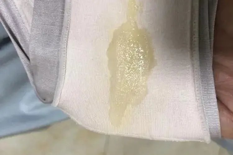 宫颈癌晚期内裤图片