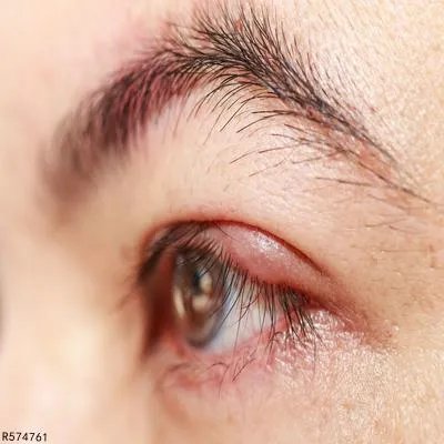 眉毛里长痘是怎么回事 眉毛里长痘与这些原因有关