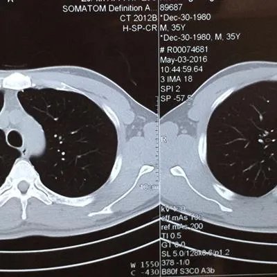 掏耳朵咳嗽是怎么回事?