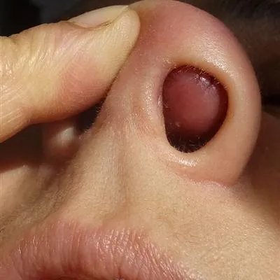 鼻出血怎么回事?