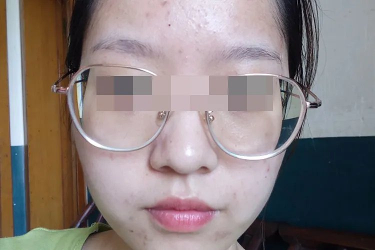 针清过程恢复图