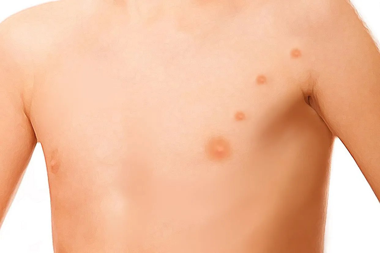 儿童多乳症图片