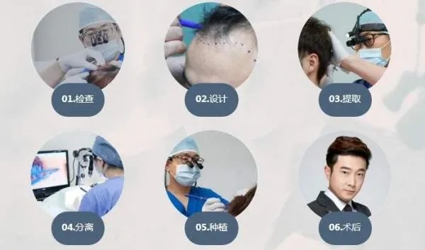 毛发种植的危害有哪些