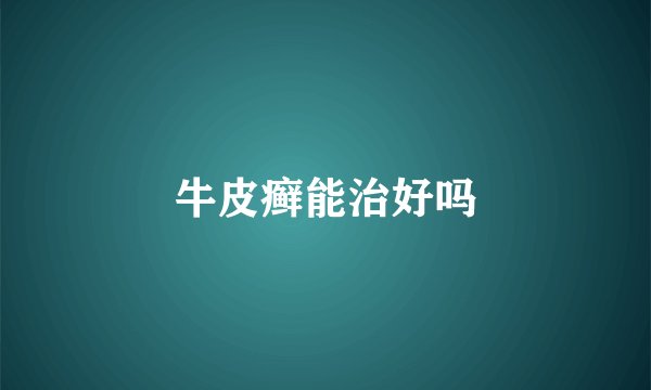 牛皮癣能治好吗
