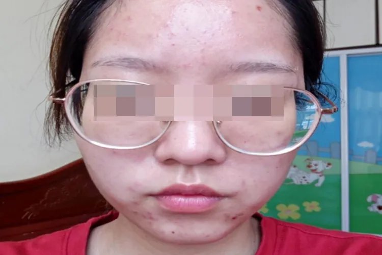 针清过程恢复图