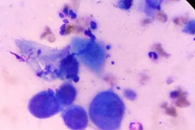 单纯疱疹病毒感染是怎么引起的