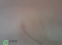 假体隆胸取出后悔死了 假体隆胸取出后图片