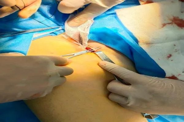 激光结扎手术图片